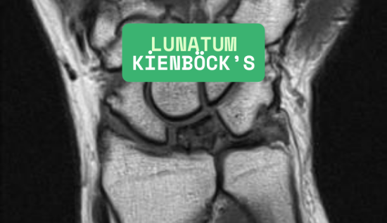 Lunatum Kienböck's Hastalığı