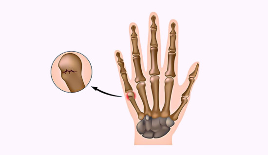 Boksör Kırığı (Boxer's Fracture)