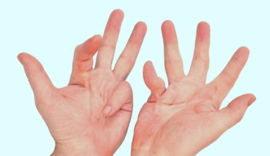 Dupuytren Kontraktürü