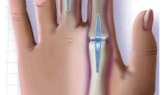 Silikone Parmak Eklem Protezi