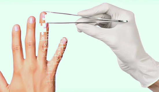 Parmak Ucu Yaralanmaları ve Kopmaları